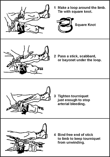 Figure 4-4. Application of Tourniquet